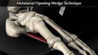 Hallux Valgus Correction with Bunionectomy, Lateral Release, and Proximal Opening Wedge Osteotomy...