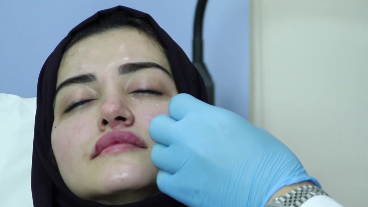 فيلر تحت العين والخدود للدكتور امير مراد استشاري جراحة التجميل بالرياض