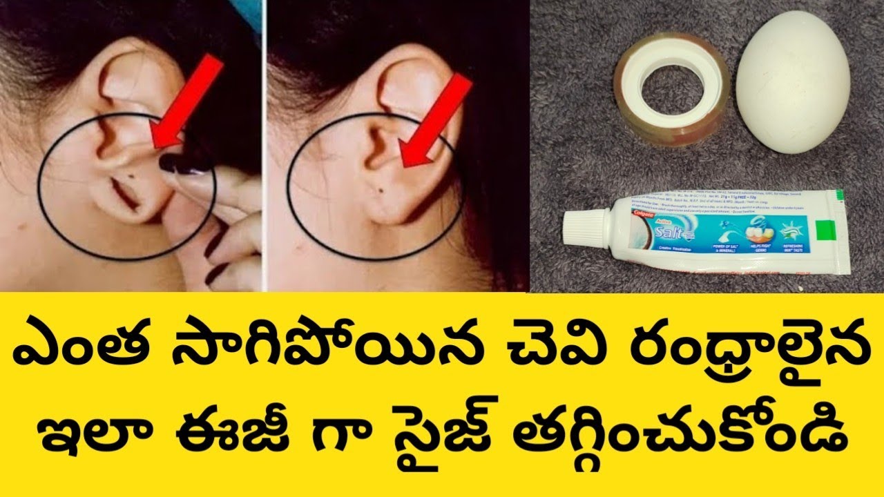 సాగిపోయి పెద్దవిగా మారిన చెవి రంధ్రాలు చిన్నవిగా మారాలంటే | How To Shrink Earlobes At Home 💯% Result