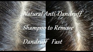 Want to get rid of dandruff fast? quick relief from itching and
irritating scalp? try this homemade anti-dandruff shampoo that removes
in one w...