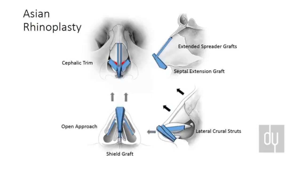 Asian Rhinoplasty Surgical Techniques & Autologous Grafting YouTube