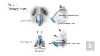 Asian Rhinoplasty - Surgical Techniques & Autologous Grafting