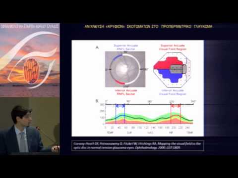 Προφορική Ανακοίνωση:Ανίχνευση "κρυφίων" σκοτωμάτων στο προπεριμετρικό γλαύκωμα