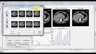 Lung Nodule Detection And Classification Using Neural Network And SVM With Fractal Features