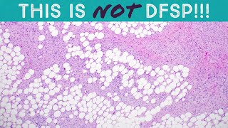 Diffuse neurofibroma in NF1 neurofibromatosis(don't misdiagnose as dermatofibrosarcoma protuberans!)