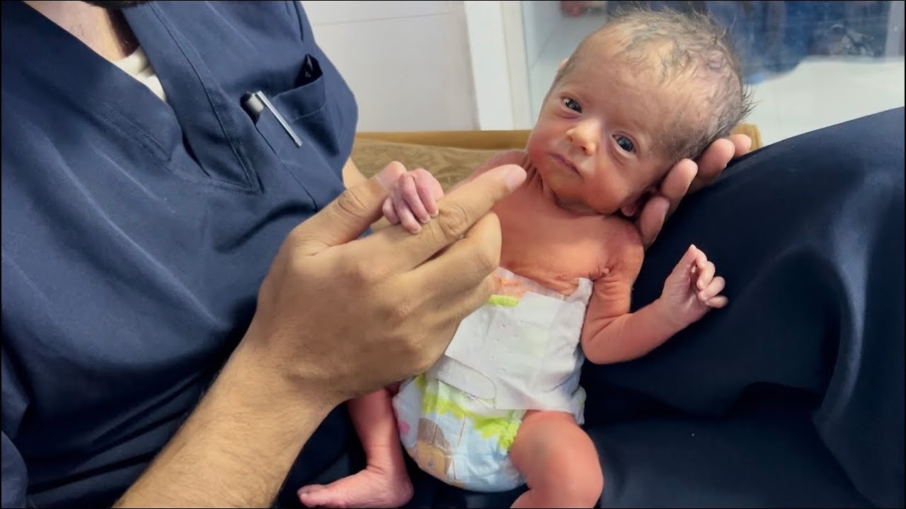 Tiny Hydrocephalus Warrior’s First Hug & Feeding Moment 💖🤗