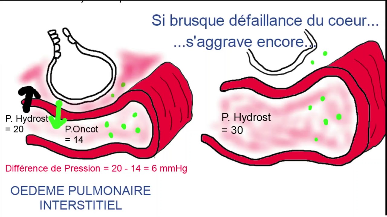 Oedme aigu pulmonaire