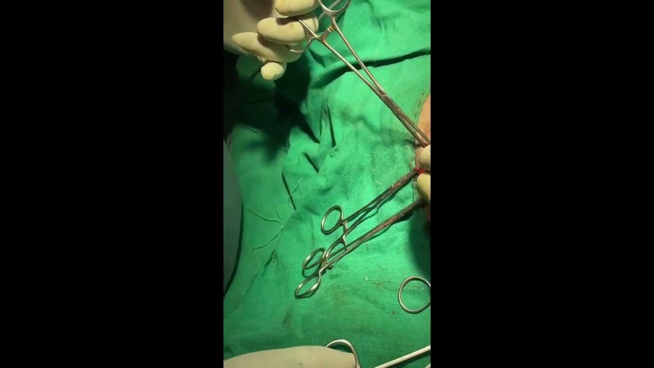Cryptorchidismsurgery YouTube