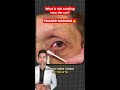 What a Tear Sac Infection Looks Like