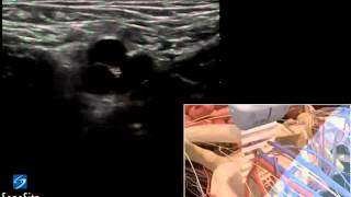 3D How-To: Ultrasound-Guided Insertion of Catheter into Femoral Artery - SonoSite Ultrasound