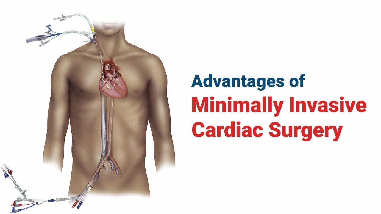 Minimally Invasive Cardiac Surgery (MICS) at Prathima Hospitals