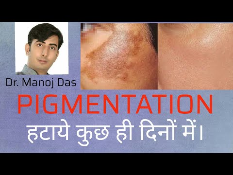 How to remove pigmentationIRemove Dark Spots,Pigmentation-Dr.manoj das