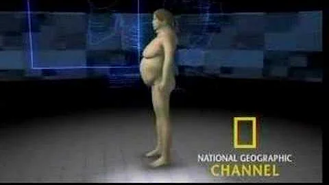 NGC Special on Obesity-Cushing'...  Segment