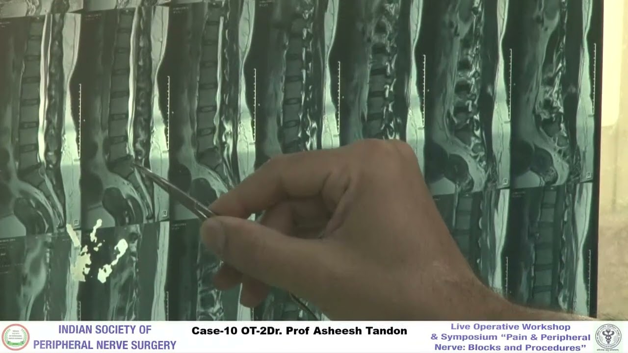 Case: 10, OT-2  | Pain workshop Day-1 (14 Sep 2023) | TV Health