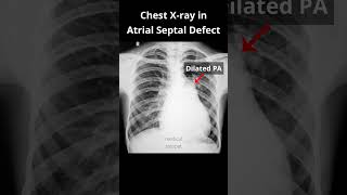 Chest Xray Part 2 In Atrial Septal Defect Asd