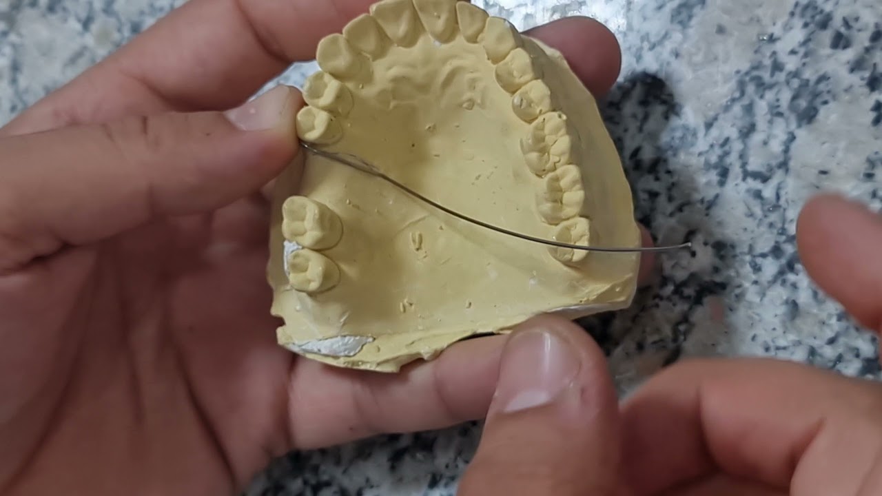 ProsProsthodontics c clasp