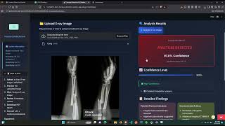 Bone fracture detection system