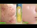 DIY CLEAR SKIN MIRACLE | How To Get Rid Of Acne, Pimples, Texture, Grow Long Nails & Hair w/ 1 DRINK