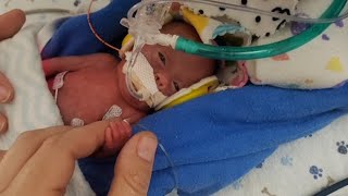 Youngest Surviving Premature Baby Stuns Doctors