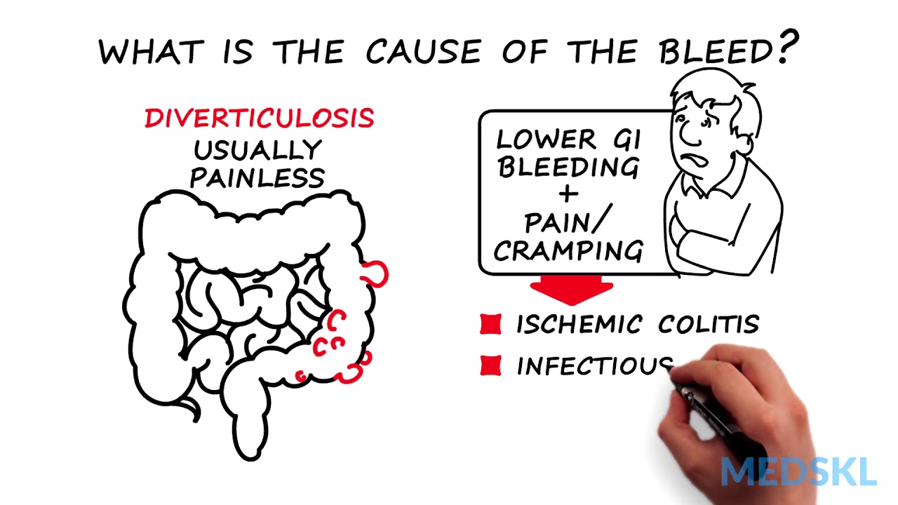 Lower Gi Bleeding The 3 Steps To Take When You Aren T Sure Of The Source Youtube