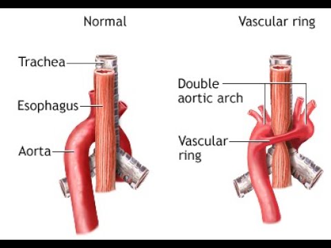 Кольца пищевода. Персистирование дуги аорты. Сосудистое кольцо двойная дуга аорты. Аномалия положения дуги аорты. Персистирование обеих дуг аорты.