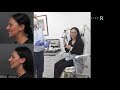 Diamond rhinoplasty 💎 Natural reaction 6 days after ultrasonic nose job with Dr. Mireas