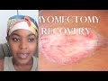 My Myomectomy Surgery Experience - Six Fibroids Removed