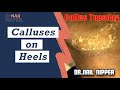 Calluses on Heels [Callus Tuesday] (2020)