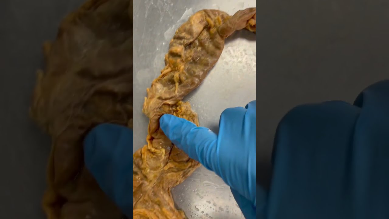 A REAL Human Colon Constipation