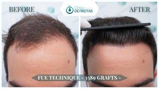 Hair Graft Technique FUE - 3.589 Grafts (9.1178 Hairs) - Dr. Rafael de Freitas