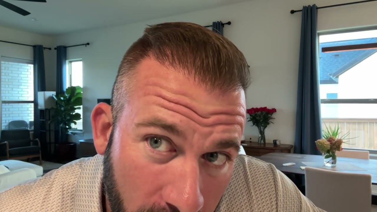 Cosmedica Hair transplant update month 6