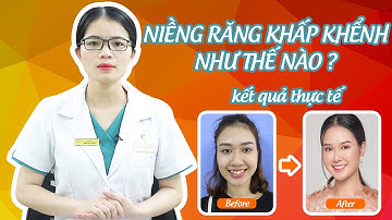 Niềng răng khấp khểnh như thế nào?  có đau không?