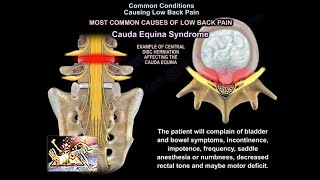 Common Causes of Low Back Pain - Everything You Need To Know - Dr. Nabil Ebraheim