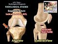 ACL Tears Radiological Evaluation - Everything You Need To Know - Dr. Nabil Ebraheim