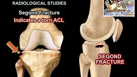 ACL Tears Radiological Evaluation - Everything You Need To Know - Dr. Nabil Ebraheim