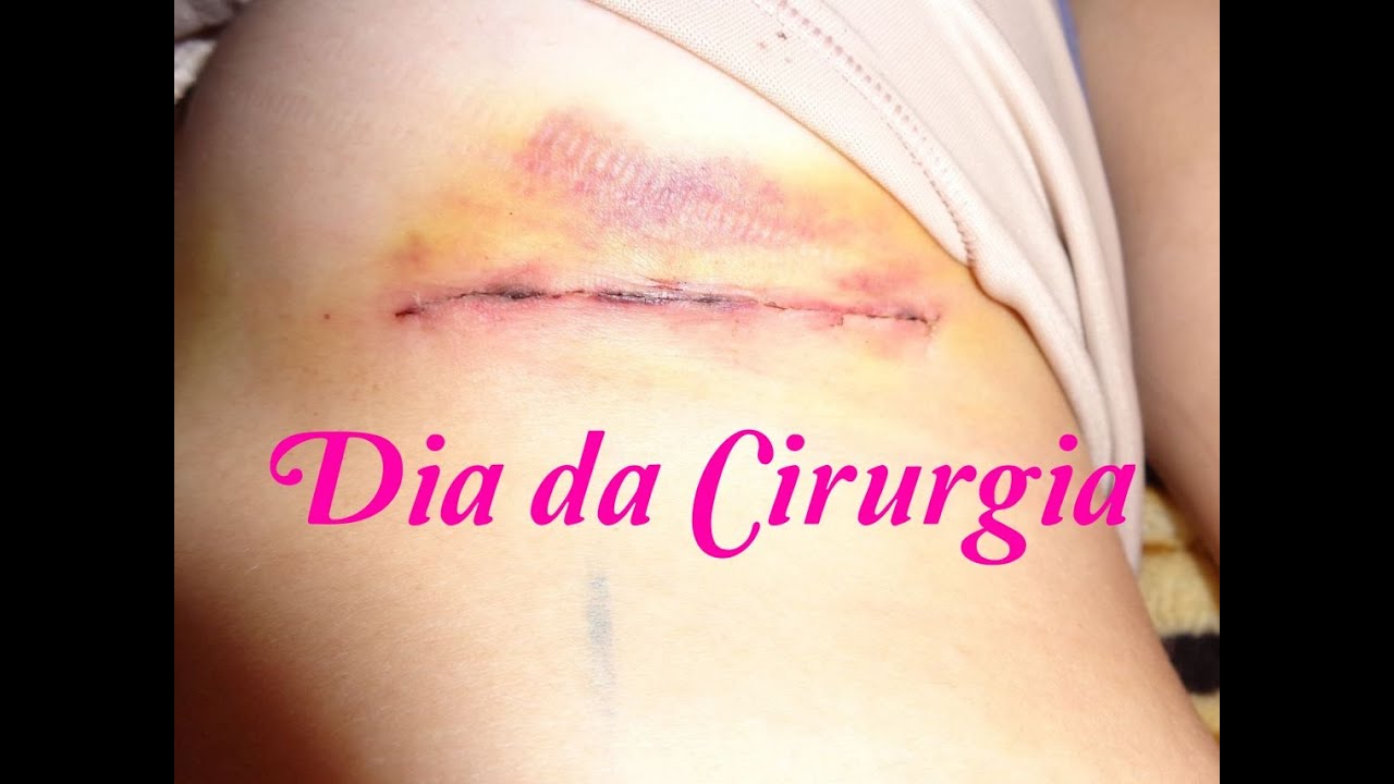 CIRURGIA DE SILICONE: Dia da cirurgia (acordei durante a cirurgia