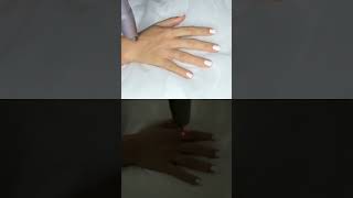 Rejuvenecimiento MANOS, Manchas solares, Pigmentación Омоложение РУК, пигментных старческих пятен