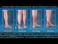 Understanding Varicose Veins &amp; Spider Veins: Causes, Symptoms, and Treatment Options.