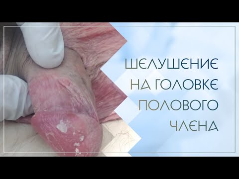 😲 Шелушение на головке полового члена. Клинический случай №56