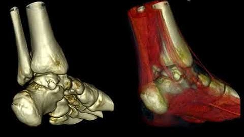 MDCT of Ankle and Foot Trauma: Findings not to Miss, by Geoffrey Riley, MD