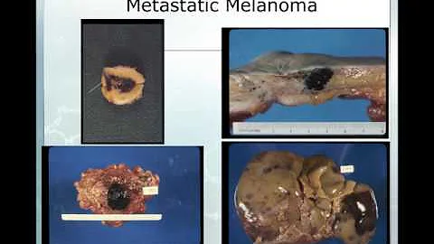 Metastasis - DayDayNews
