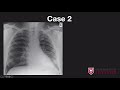 Chest xray case review