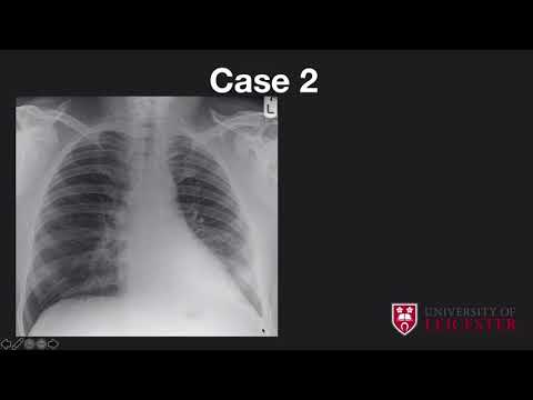 case study chest x ray