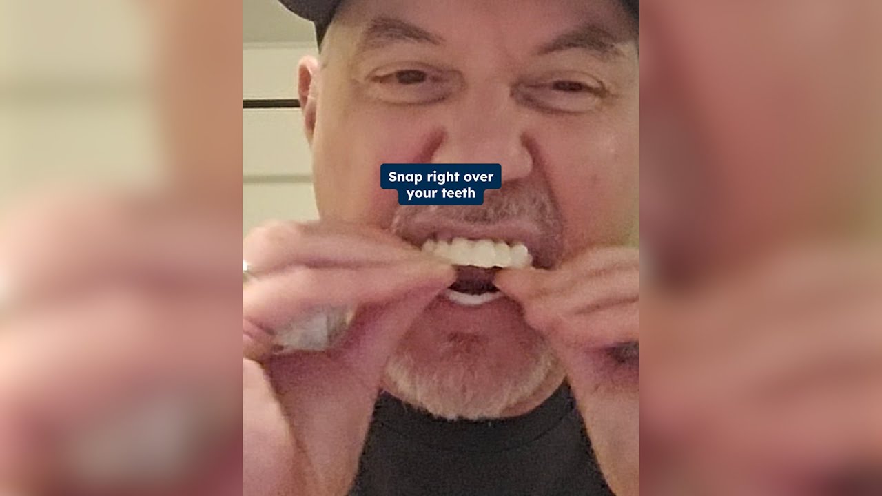 The price of these veneers is incredible!🤯