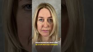 Смас подтяжка лица #пластическийхирург #beforeandafter #подтяжкалица