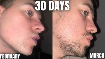 INSANE Beard growth in only 30 Days using MINOXIDIL and DERMA ROLLING