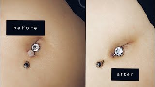 HOW TO TREAT NAVEL PIERCING KELOIDS // LIV