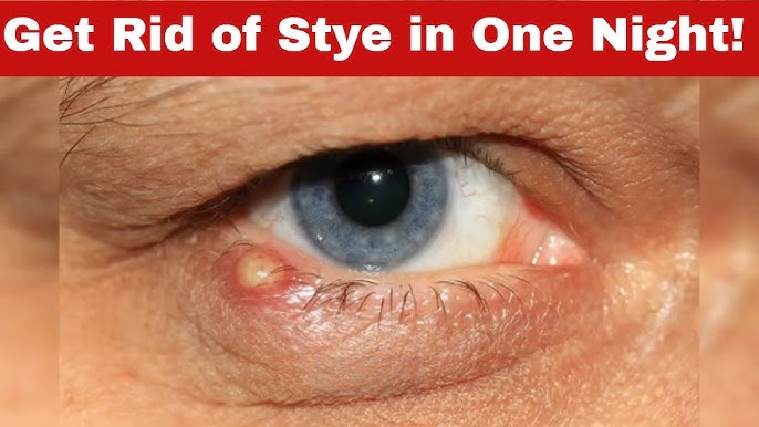 5 Ways To Overnight Stye Removal Effective Home 2024