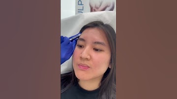 Getting rid of my wrinkles with botox #shorts #antiaging #satisfying #skincare #botox #filler #acne