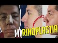 ¡ME OPERÉ LA NARIZ! || RINOPLASTIA: Mi experiencia día a día || NOS METIMOS AL QUIROFANO